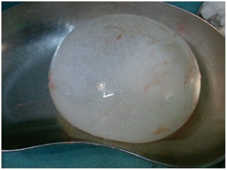 Figure-6: Large hydatid cyst of brain